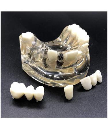 Implant Tooth Template | Oral Simulation Dental Study Model for Teaching - Shop Internationally - Buy Online on SooperMarket.com