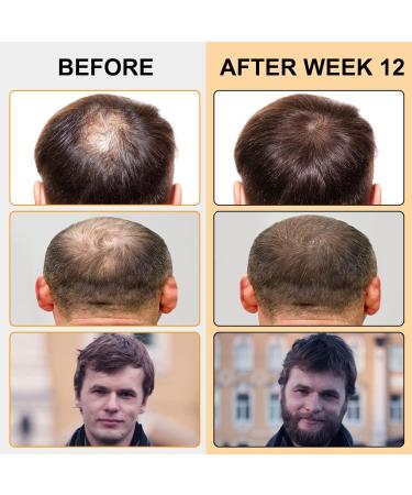 Minoxidil 5% Foam for Men with Biotin - Hair & Beard Growth Treatment (3 Pack) - Buy Online on SooperMarket.com