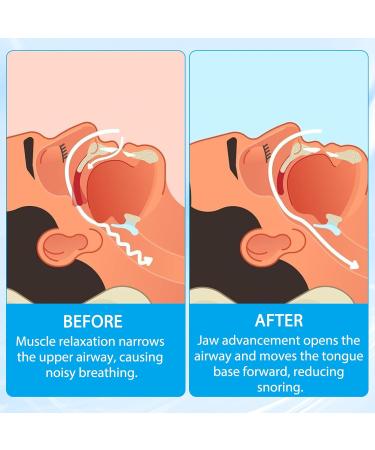 Anti Snoring Devices for Sleep Anti Snoring Mouthpiece Anti Snoring Mouth Guard Stop Sleeping Snore Snoring Solution - Buy Online on SooperMarket.com