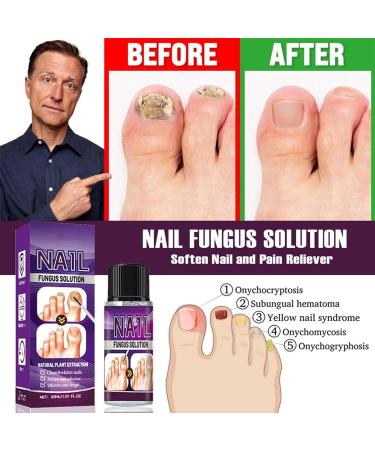 Fungal Nail Treatment 30ml Extra Strong Nail Fungus Treatment for Toenail and Fingernail Premium Fungal Nail Eliminator Anti fungus Nail Repair and Strengthen Fix & Renew Damaged Broken Nails - Buy Online on SooperMarket.com