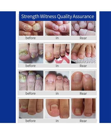 Fungal Nail Treatment For Toenails - Extra Strong Nail Fungus Treatment for Toenail - Toe Nail Fungal Treatment - Anti-Fungal Nail Repair Treatment with Nail File and Nail Brush - Buy Online on SooperMarket.com