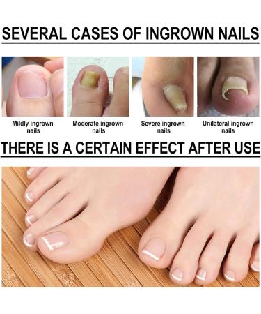Ingrown Toenail Treatment and Removal Relief Oil - Nail Growth and Fungal Corrector - Buy Online on SooperMarket.com