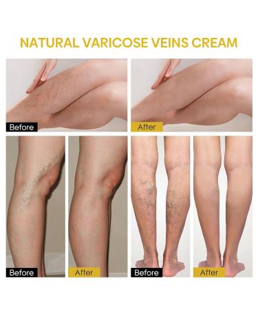 Furzero Bienengift Varicose Veins Cream - Test Winner Spider Vein Relief | 5-Piece Beeergift Pain Cream for Everyone | International Shipping Available - Buy Online on SooperMarket.com