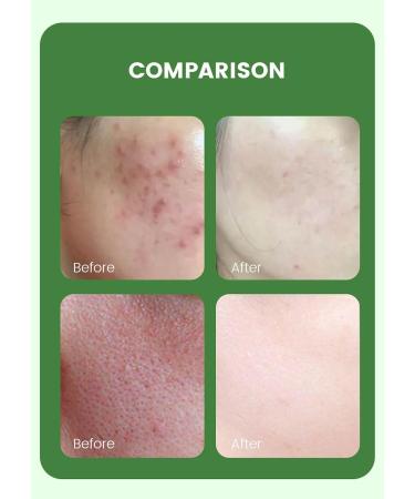 PrimeCove - 5% Azelaic Acid Facial Cream (50g) | Lightweight Hydrating Formula With Niacinamide For Clearer & Brighter Skin - Buy Online on SooperMarket.com