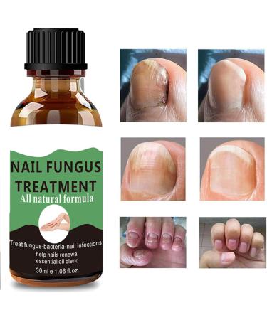 Nail Fungus Treatment For Toenail - Extra Strong Fungal Nail Treatment - Anti fungus Nail Repair and Strengthen Fix & Renew Damaged Broken Nails (2PC) - Buy Online on SooperMarket.com