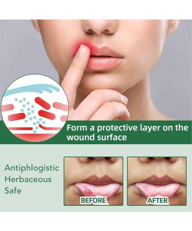 Mundspray - Ultimate Oral Ulcer Relief Bad Breath Reduction Dry Mouth Treatment & Gum Protection | Shop Now! - Buy Online on SooperMarket.com
