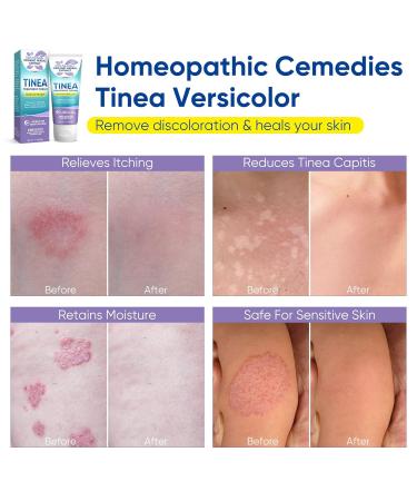 Tinea Versicolor Natural Skin Cream - Effective Treatment for All Skin Types - Buy Online on SooperMarket.com