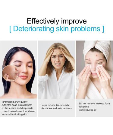 Buy Salicylic Acid 2% Serum - Acne Treatment & Pore Minimizer | Clear Skin Solution 1 FL OZ - Buy Online on SooperMarket.com