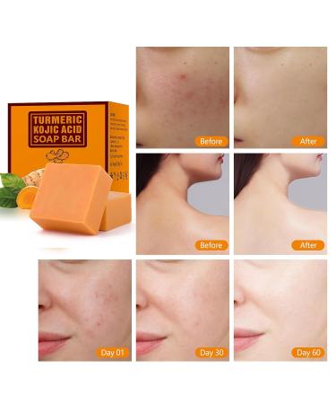 Tamoskiny Kojic Acid & Turmeric Soap for Dark Spots & Acne - 2 Pack 200g/7OZ - Buy Online on SooperMarket.com
