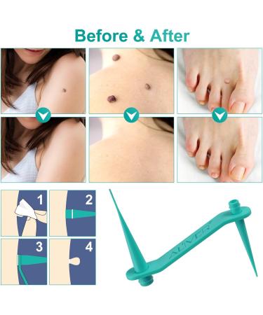 Skin Tag Remover 2 in 1 Kit for Medium/Large Skin Tags - Painless Mole Wart Treatment Tool for Face and Body - Buy Online on SooperMarket.com