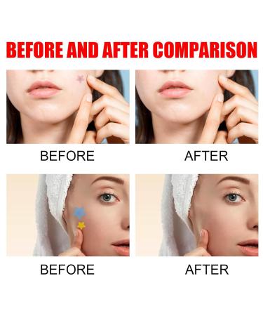 200 Star Shaped Pimple Patches - Hydrocolloid Acne Spot Cover Stickers for Effective Skin Care | International Shipping Available - Buy Online on SooperMarket.com