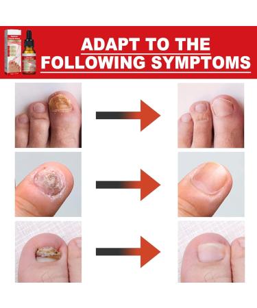Ingrown Toenail Treatment Nail Growth Ingrowing Toenail Treatment Nail Helper Fungal Nail Treatment Correction Oil Drops Ingrown Toenail Corrector Toe Nail Fungus Treatment Cuticle Oil - Buy Online on SooperMarket.com