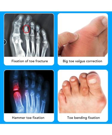 TMISHION Hammer Toe Straightener - Cushioned Bandage for Toe Straightening and Stress Reduction - Adjustable Claw Corrector for Right Foot - Buy Online on SooperMarket.com