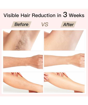 BoSidin IPL Laser Hair Removal Painless 2-in-1 Face Rejuvenation 6+1 Modes 6 Levels Permanent Hair Removal Kit for Women with Shaver & Goggles - Buy Online on SooperMarket.com