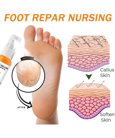 Foot Callus Removal Spray | Instant Peel Off for Cracked Heels & Dry Skin | Orange Oil Infused | Nourishing Foot Care (1PCS) - Buy Online on SooperMarket.com