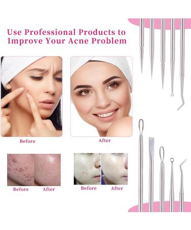 Professional Blackhead and Whitehead Extractor Tool Kit - 5 Pcs/Set for Face and Nose - Stainless Steel Pimple Popper Set VT921A - Buy Online on SooperMarket.com