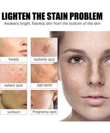 Dark Spot Remover Hyperpigmentation Treatment Dark Spot Corrector for Face Freckle Remover Cream Age Spots & Sunspots & Melasma Cream Even Skin Tone Moisturizing Erase Fine Lines Firming - Buy Online on SooperMarket.com