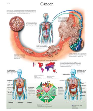 3B Scientific VR1753L Glossy UV Resistant Laminated Paper Cancer Anatomical Chart Poster Size 20-Inch Widthx26-Inch Height
