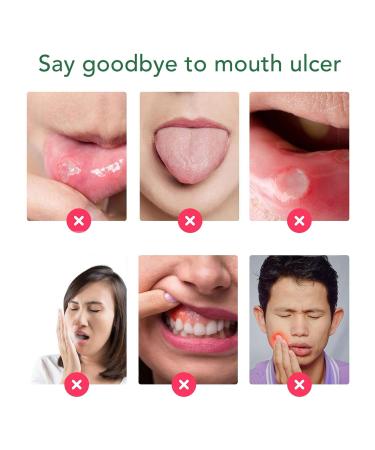 Mundspray - Ultimate Oral Ulcer Relief Bad Breath Reduction Dry Mouth Treatment & Gum Protection | Shop Now! - Buy Online on SooperMarket.com