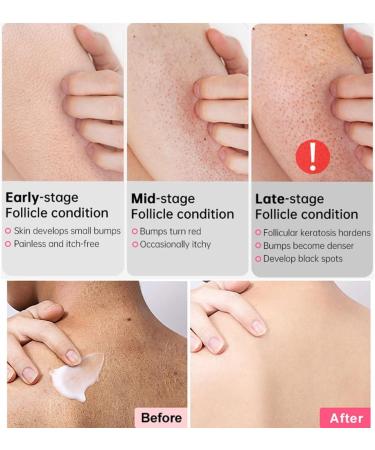 Keratosis Pilaris Cream Chicken Skin Care Cream Skin Exfoliating Repair Cream Keratosis Pilaris Treatment Legs Treatment Body Cream Rough Skin Cream For Rough And Bumpy Dry Skin 50g - Buy Online on SooperMarket.com