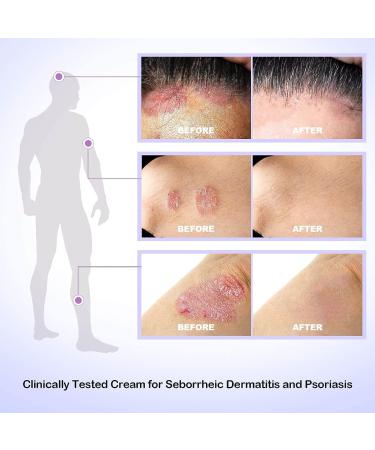 Dr. DERM Seborrheic Dermatitis Cream - Psoriasis Scalp Treatment for Folliculitis, Dry Scalp & Dandruff - Anti-Itch & Soothing Relief - 3.4 Fl Oz - Buy Online on SooperMarket.com