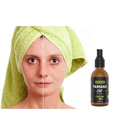 Organic Tamanu Oil - Natural Psoriasis Treatment Eczema Relief & Acne Scars - Cold Pressed & International Shipping - Buy Online on SooperMarket.com
