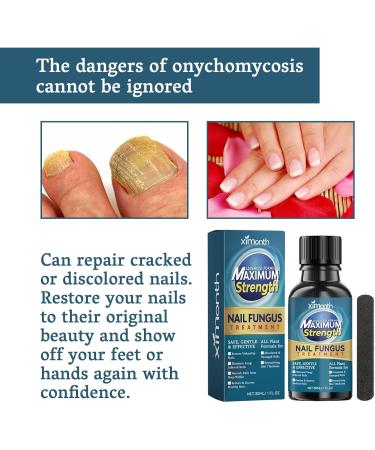 Fungal Nail Treatment - Extra Strong Nail Fungus Treatment for Toenail and Fingernail - Fungal Nail Eliminator Anti fungus Nail Repair and Strengthen Fix & Renew Damaged Broken Nails 30ml - Buy Online on SooperMarket.com