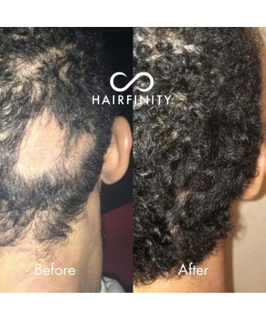 Hairfinity Infinite Edges Hair Serum - Hair Growth Treatment for Alopecia - Stimulates Hair Follicles, Prevents Hair Loss, and Promotes Regrowth - Sulfate & Silicone Free - Buy Online on SooperMarket.com