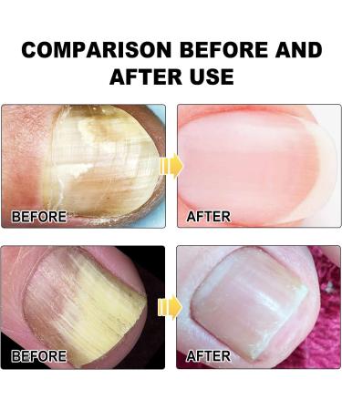 SenhE Fungus Laser Therapy Device Antibacterial Laser Equipment Light Therapy Device Fungal Nail Revolutionary High-Efficiency Light Therapy Device for Toenail Diseases  - Buy Online on SooperMarket.com