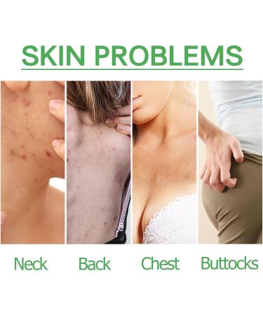 Trendyfave Dark Spot Correcting Glow Serum Skin Tag Removal Age Spot Remover For Face Scar Treatment Pore Minimizer Serums Skincare Contains Tea Tree Oil Vitamin E Body Acne Treatment 30ml - Buy Online on SooperMarket.com