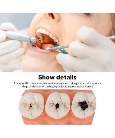 4-Fold Dental Caries Model - Synthetic Resin Oral Care Training Tool for Students | Safe & Realistic Simulation - Buy Online on SooperMarket.com