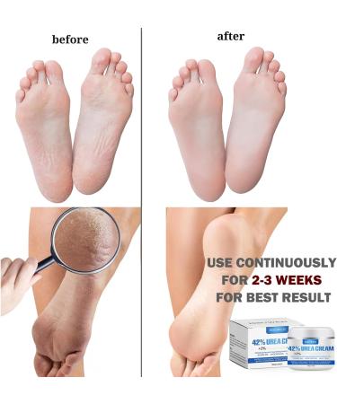 Urea 42% Foot Cream for Cracked Heel Repair and Callus Remover - Maximum Strength for Dry and Hard Skin - 100g (Original Scent) - Buy Online on SooperMarket.com