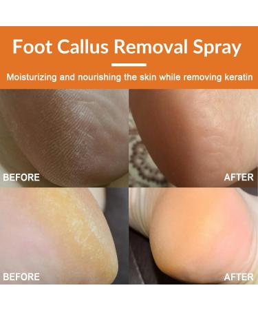 Tongyend Foot Peeling Spray Foot Callus Removal Spray Foot Peel Spray Instant Foot Peeling Spray Orange Oil Soften& Moisturize Peel-Off Spray for Cracked Rough Dry Skin Foot Care - Buy Online on SooperMarket.com