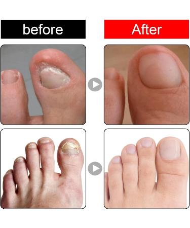 Ingrown Toenail Treatment and Removal Relief Oil - Nail Growth and Fungal Corrector - Buy Online on SooperMarket.com