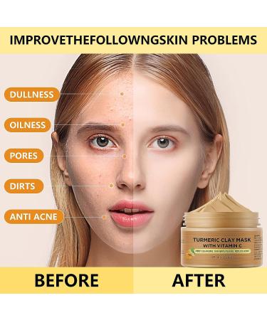 Turmeric & Vitamin C Clay Face Mask for Dark Spots | Blackhead Remover & Deep Cleansing Facial Mask 4.2OZ - Buy Online on SooperMarket.com