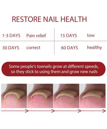 Toenailplus Anti Paronychia Relief Oil - 10ml 2pcs - Nail Helper for Ingrowth Toenail Correction & Paronychia Treatment - Buy Online on SooperMarket.com