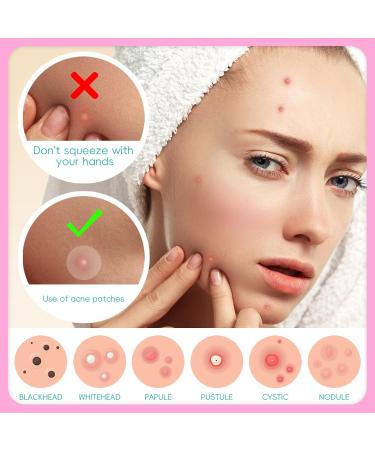 EFLY Hydrocolloid Pimple Patches with Tea Tree Oil & Salicylic Acid Invisible Acne Dots for Face 210 Patches - Buy Online on SooperMarket.com