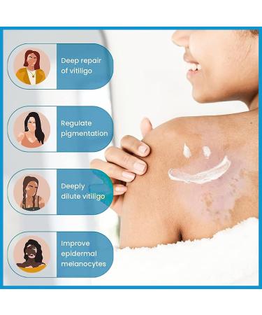 MIELIKKI Vitiligo Cream | Reduce White Spots & Enhance Skin Pigmentation | Natural Vitiligo Care Cream for All Skin Types - Buy Online on SooperMarket.com