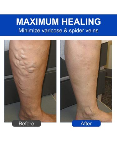 EFINITYER Varicose Veins Treatment Patch - Promotes Metabolism, Improves Blood Circulation, Relieves Heavy Tired Legs - Yellow (12 Pcs) - Buy Online on SooperMarket.com