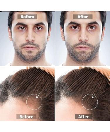 Beard Roller 0.5mm - Microneedle Dermaroller for Beard Growth & Care | 1 Pack - Buy Online on SooperMarket.com