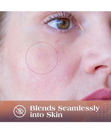 AUSLKA Pimple Patches (174 Patches) - Hydrocolloid Patches - Invisible Pimple Spot Stickers - Facial Stickers All Skin Types - Buy Online on SooperMarket.com