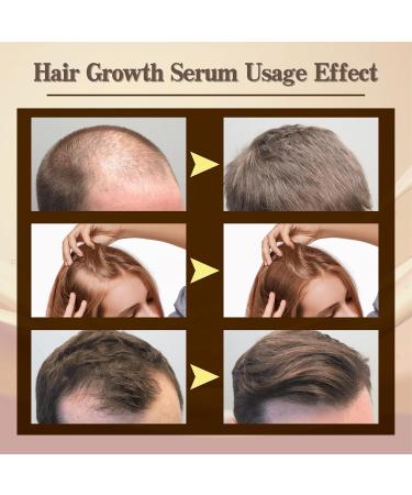 Trendyfave Hair Growth Serum Hair Serum for Hair Growth Ginger Hair Growth Serum Anti Hair Loss Essence for Fast Hair Growth Nourishing Repair Damaged Hair Stimulates Hair Growth Serum for Women Men - Buy Online on SooperMarket.com
