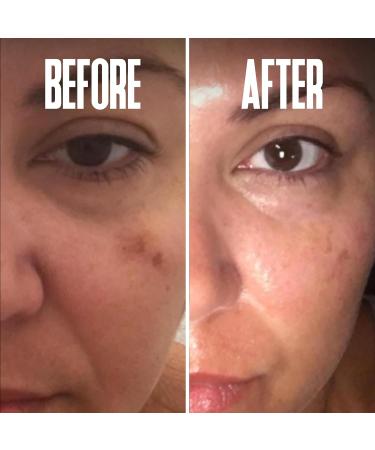 Dark Spot Corrector Serum - Remove Stubborn Dark Spots with Kojic Acid & Alpha Arbutin | Brightening Discoloration Remover for Face - Buy Online on SooperMarket.com