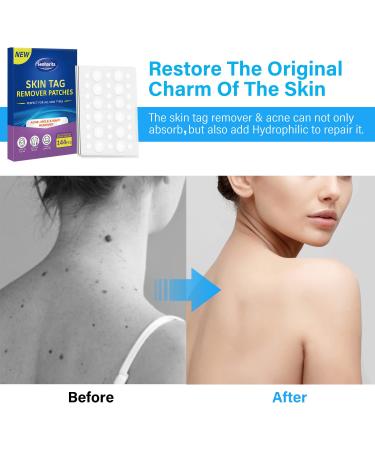 Skin Tag Remover Patches - 144Pcs | Safe & Painless Wart Removal for Face & Body - Buy Online on SooperMarket.com