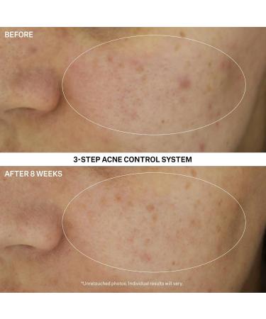 StriVectin Multi Action Clear Acne Treatment Set | 30-Day Trial Kit for Clearer Smoother Skin | Blemish Control & Breakout Defense - Buy Online on SooperMarket.com