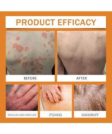 Bee Venom Psoriasis Cream Bee Venom Cream for Psoriasis New Zealand Bee Venom Body Care Chinese Herbal Cream Soothing Psoriasis Cream Body Cream for Redness & Itching & Soothing (1) - Buy Online on SooperMarket.com