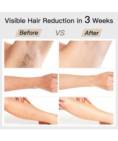 BoSidin IPL Laser Hair Removal Kit | Painless Ice-Cooling 6 Modes 2-in-1 Face Rejuvenation Women's Permanent Hair Removal | International Shipping Available - Buy Online on SooperMarket.com