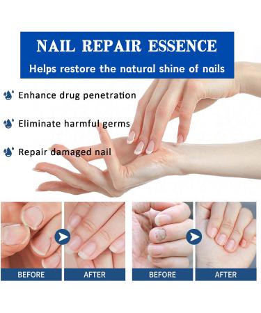 Fungal Nail Treatment 30ML Nail Fungus Serum for Toenail Extra Strong Gentle Anti Fungal Nail Serum Protects Thick Broken Discolored Nails Restoring Healthy Nails For Finger And Toe Nail Fungal - Buy Online on SooperMarket.com