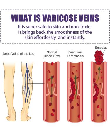 Varicose Vein & Spider Vein Cream | Capillary Health Treatment | Improve Circulation 0.7oz - Buy Online on SooperMarket.com