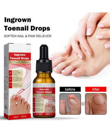 Ingrown Toenail Treatment Oil - Natural Solution for Ingrown Toenails & Fungal Nail Care | 1PCS - Buy Online on SooperMarket.com